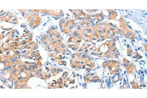 Immunohistochemistry of paraffin-embedded Human lung cancer using AUP1 Polyclonal Antibody at dilution of 1:50 (Ancient Ubiquitous Protein 1 Antikörper)