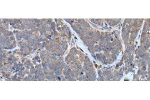 Immunohistochemistry of paraffin-embedded Human thyroid cancer tissue using TNMD Polyclonal Antibody at dilution of 1:40(x200) (TNMD Antikörper)