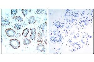 Immunohistochemical analysis of paraffin-embedded human breast carcinoma tissue, using BIM (Ab-65) antibody (E021280). (BIM Antikörper)