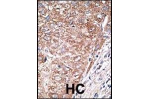 Formalin-fixed and paraffin-embedded human cancer tissue reacted with the primary antibody, which was peroxidase-conjugated to the secondary antibody, followed by DAB staining. (Nestin Antikörper  (C-Term))