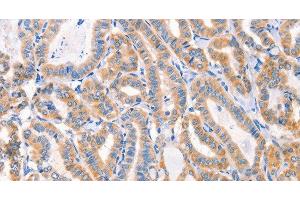 Immunohistochemistry of paraffin-embedded Human thyroid cancer tissue using Factor XIIIa Polyclonal Antibody at dilution 1:80 (F13A1 Antikörper)