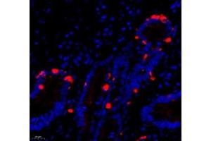 Immunofluorescence of paraffin embedded human gastric cancer using DCR3 (ABIN7076071) at dilution of 1: 700 (400x lens) (TNFRSF6B Antikörper)