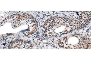 Immunohistochemistry of paraffin-embedded Human cervical cancer tissue using PRNP Polyclonal Antibody at dilution of 1:45(x200) (PRNP Antikörper)