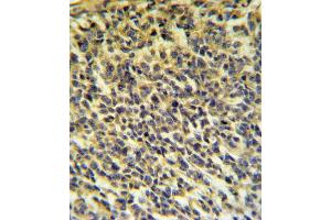 PLA2G6 Antibody IHC analysis in formalin fixed and paraffin embedded testis carcinoma followed by peroxidase conjugation of the secondary antibody and DAB staining. (PLA2G6 Antikörper  (AA 551-580))