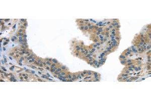 Immunohistochemistry of paraffin-embedded Human thyroid cancer tissue using VLDLR Polyclonal Antibody at dilution 1:40 (VLDLR Antikörper)