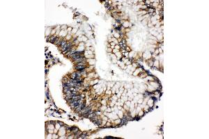 Anti-SOD2 antibody, IHC(P) IHC(P): Human Intestinal Cancer Tissue (SOD2 Antikörper  (N-Term))