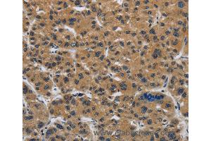 Immunohistochemistry of Human gastric cancer using CLDN2 Polyclonal Antibody at dilution of 1:50 (Claudin 2 Antikörper)