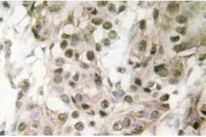 Immunohistochemistry (IHC) analyzes of Nucleophosmin antibody in paraffin-embedded human breast carcinoma tissue. (NPM1 Antikörper)