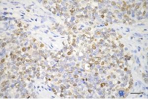 Immunohistochemistry was performed on paraffin-embedded human breast carcinoma using proliferating cell nuclear antigen antibody (ABIN7799915), 1:200). (PCNA Antikörper)