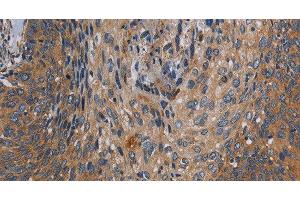 Immunohistochemistry of paraffin-embedded Human cervical cancer tissue using PARP10 Polyclonal Antibody at dilution 1:30 (PARP10 Antikörper)
