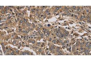 Immunohistochemistry of paraffin-embedded Human liver cancer using KIF22 Polyclonal Antibody at dilution of 1:30 (KIF22 Antikörper)