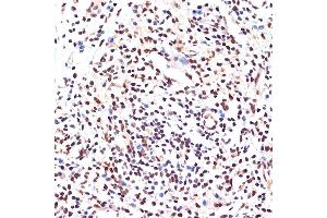 Immunohistochemistry of paraffin-embedded human breast cancer using P Rabbit mAb (ABIN7269156) at dilution of 1:100 (40x lens). (PAX9 Antikörper)