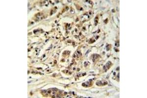 Immunohistochemistry analysis in formalin fixed and paraffin embedded breast carcinoma reacted with METT11D1 Antibody (N-term) followed which was followed by peroxidase conjugated to the secondary antibody and followed by DAB staining. (METTL17 Antikörper  (N-Term))