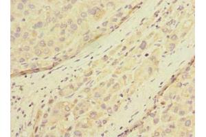 Immunohistochemistry of paraffin-embedded human liver cancer using ABIN7165883 at dilution of 1:100 (POMGNT1 Antikörper  (AA 59-300))
