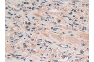 DAB staining on IHC-P; Samples: Human Prostate cancer Tissue (GSAP Antikörper  (AA 616-854))