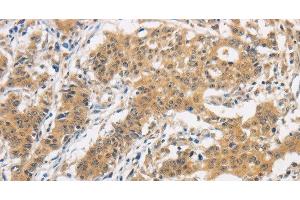Immunohistochemistry of paraffin-embedded Human gasrtic cancer tissue using ITGB3BP Polyclonal Antibody at dilution 1:50 (ITGB3BP Antikörper)