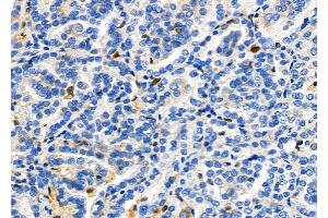 ABIN6264984 and ABIN6278347 at 1/100 staining Human kidney cancer by IHC-P. (SENP2 Antikörper  (C-Term))