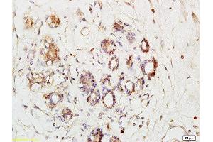Formalin-fixed and paraffin embedded human breast cancer labeled with Anti-Phospho-Ack1(Tyr284)Polyclonal Antibody, Unconjugated  at 1:200 followed by conjugation to the secondary antibody and DAB staining (TNK2 Antikörper  (pTyr284))