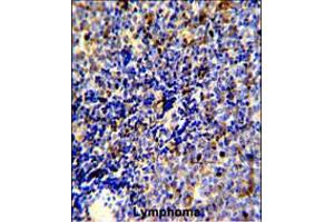 Formalin-fixed and paraffin-embedded human lymphoma reacted with MERTK Antibody, which was peroxidase-conjugated to the secondary antibody, followed by DAB staining. (MERTK Antikörper)