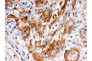 SFRP4 was detected in paraffin-embedded sections of human endometrial carcinoma tissues using rabbit anti SFRP4 Antigen Affinity purified polyclonal antibody at 1 μg/mL. (SFRP4 Antikörper  (AA 22-303))