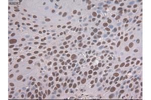 Immunohistochemical staining of paraffin-embedded Adenocarcinoma of colon tissue using anti-NOTCH1mouse monoclonal antibody. (Notch1 Antikörper  (AA 2300-2556))