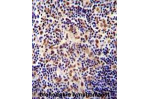 TIGD3 antibody (C-term) immunohistochemistry analysis in formalin fixed and paraffin embedded human hodgkin lymphoma followed by peroxidase conjugation of the secondary antibody and DAB staining. (TIGD3 Antikörper  (C-Term))
