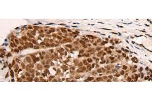 Immunohistochemistry of paraffin-embedded Human thyroid cancer tissue using HGH1 Polyclonal Antibody at dilution of 1:45(x200) (FAM203B Antikörper)