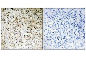 Immunohistochemistry analysis of paraffin-embedded human liver carcinoma tissue using TAF5 antibody. (TAF5 Antikörper  (Internal Region))