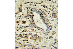 APOL1 Antibody IHC analysis in formalin fixed and paraffin embedded human breast carcinoma followed by peroxidase conjugation of the secondary antibody and DAB staining. (APOL1 Antikörper  (AA 137-171))