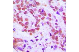 Immunohistochemical analysis of RFX3 staining in human breast cancer formalin fixed paraffin embedded tissue section. (RFX3 Antikörper  (C-Term))