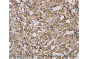 Immunohistochemistry of Human gastric cancer using DCN Polyclonal Antibody at dilution of 1:30 (Decorin Antikörper)