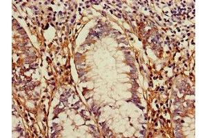 Immunohistochemistry of paraffin-embedded human colon cancer using ABIN7172274 at dilution of 1:100 (TLR5 Antikörper  (AA 682-850))