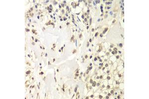 Immunohistochemistry of paraffin-embedded human kidney cancer using USP7/HAUSP antibody (ABIN6132279, ABIN6150031, ABIN6150033 and ABIN6217612) at dilution of 1:200 (40x lens). (USP7 Antikörper  (AA 206-1102))