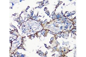 Immunohistochemistry of paraffin-embedded Human lung cancer using MMP16 Polyclonal Antibody at dilution of 1:100 (40x lens).