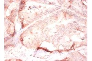 Immunohistochemistry of paraffin-embedded human colon cancer using ABIN7148243 at dilution of 1:50 (COL4a2 Antikörper  (AA 1493-1712))