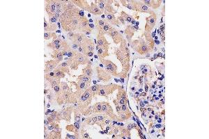 (ABIN390742 and ABIN2841007) staining Villin-1 in human kidney tissue sections by Immunohistochemistry (IHC-P - paraformaldehyde-fixed, paraffin-embedded sections). (Villin 1 Antikörper  (N-Term))