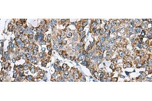Immunohistochemistry of paraffin-embedded Human liver cancer tissue using PRELID3B Polyclonal Antibody at dilution of 1:90(x200) (SLMO2 Antikörper)