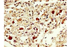 IHC image of ABIN7152301 diluted at 1:300 and staining in paraffin-embedded human melanoma performed on a Leica BondTM system. (EXOSC1 Antikörper  (AA 587-762))