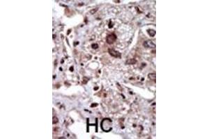 Formalin-fixed and paraffin-embedded human cancer tissue reacted with the primary antibody, which was peroxidase-conjugated to the secondary antibody, followed by DAB staining. (STK39 Antikörper  (AA 346-376))