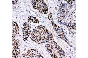 Anti-Peroxiredoxin 3 antibody, IHC(P) IHC(P): Human Lung Cancer Tissue