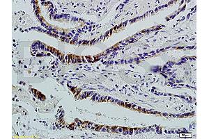 Formalin-fixed and paraffin-embedded : human colon carcinoma labeled with Rabbit Anti-Integrin ?