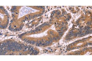 Immunohistochemistry of paraffin-embedded Human colon cancer tissue using S100A13 Polyclonal Antibody at dilution 1:40 (S100A13 Antikörper)