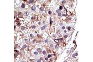IHC analysis of FFPE human hepatocarcinoma tissue stained with the SPHK2 antibody (SPHK2 Antikörper  (AA 1-30))