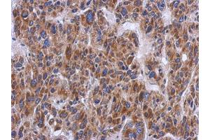IHC-P Image Immunohistochemical analysis of paraffin-embedded human hepatoma, using PTS, antibody at 1:500 dilution.