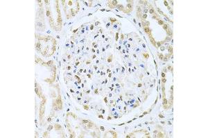 Immunohistochemistry of paraffin-embedded human kidney cancer using CBFB Antibody (ABIN6130041, ABIN6138000, ABIN6138001 and ABIN6220926) at dilution of 1:200 (40x lens). (CBFB Antikörper  (AA 1-182))