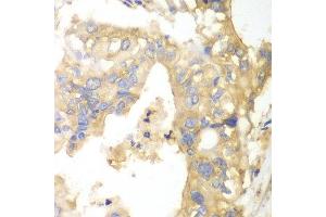 Immunohistochemistry of paraffin-embedded human liver cancer using PYGB antibody at dilution of 1:100 (x40 lens). (PYGB Antikörper)