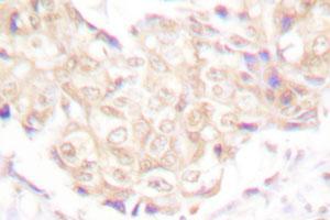 Immunohistochemical analysis of paraffin-embedded human breast cancer tissue using UBR5 polyclonal antibody . (UBR5 Antikörper)