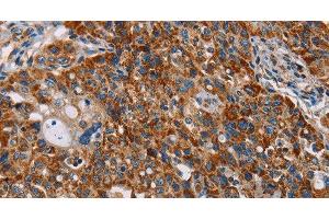 Immunohistochemistry of paraffin-embedded Human lung cancer tissue using ALG2 Polyclonal Antibody at dilution 1:35 (ALG2 Antikörper)