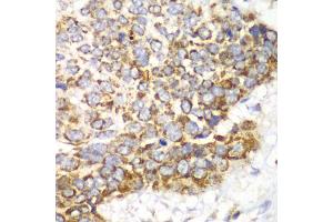 Immunohistochemistry of paraffin-embedded human esophageal cancer using TFAM antibody. (TFAM Antikörper)