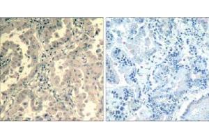 Immunohistochemical analysis of paraffin-embedded human lung carcinoma tissue using stat2 (Ab-690) Antibody (E021536). (STAT2 Antikörper)